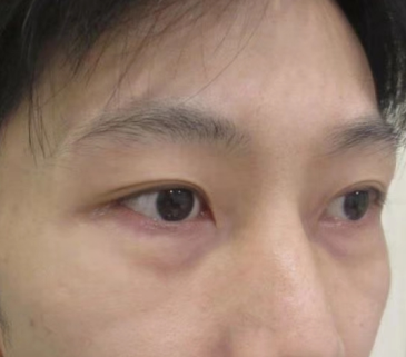 去眼袋手术