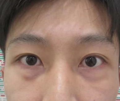 去眼袋手术