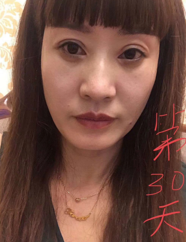 去眼袋手术