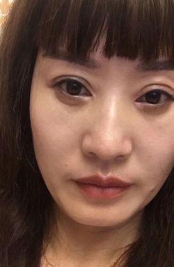 去眼袋手术