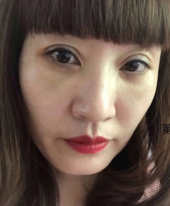 去眼袋手术