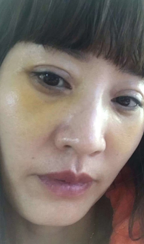 去眼袋手术