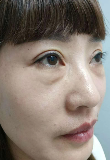 去眼袋手术