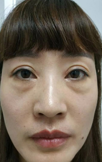 去眼袋手术