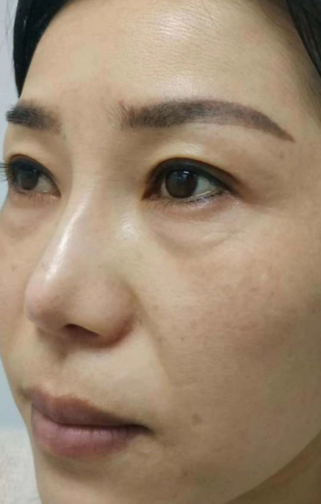 去眼袋手术