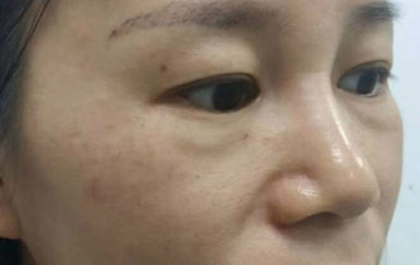 去眼袋手术