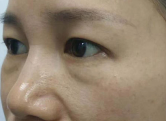 去眼袋手术