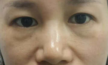 去眼袋手术