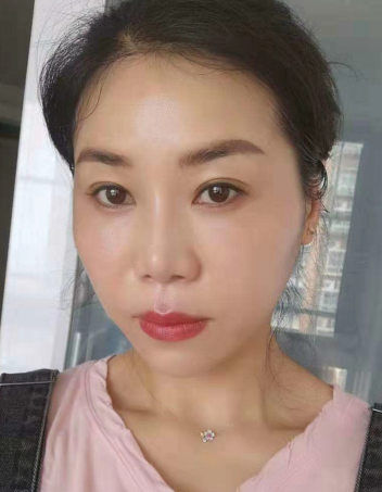 去眼袋手术