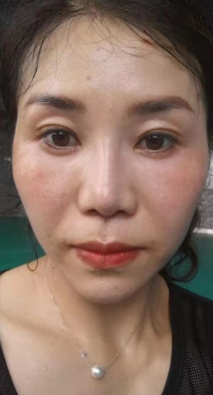 去眼袋手术