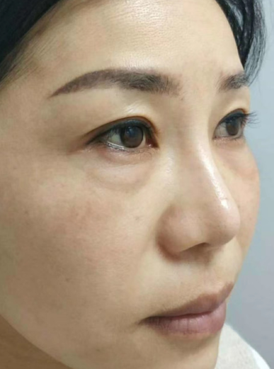 去眼袋手术