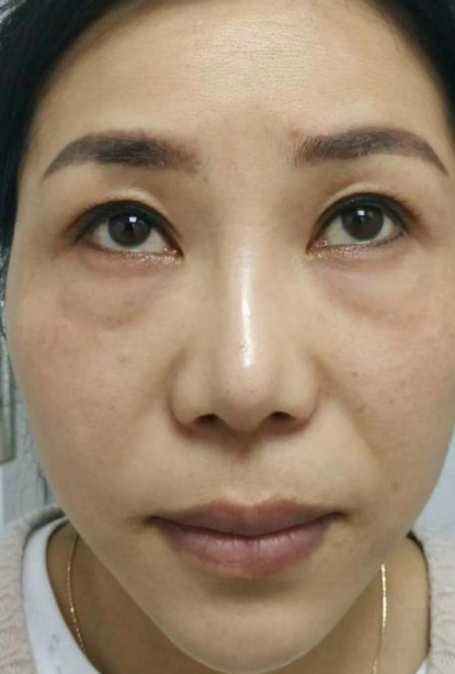 去眼袋手术
