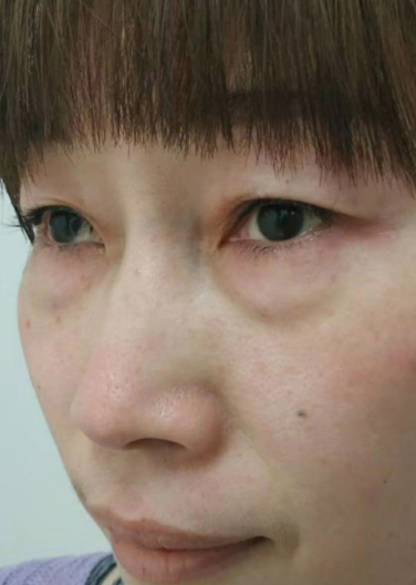 去眼袋手术