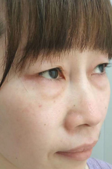 去眼袋手术