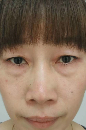 去眼袋手术