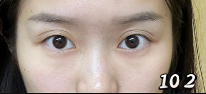 眼袋