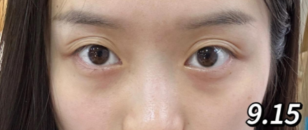 眼袋