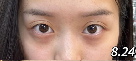 眼袋