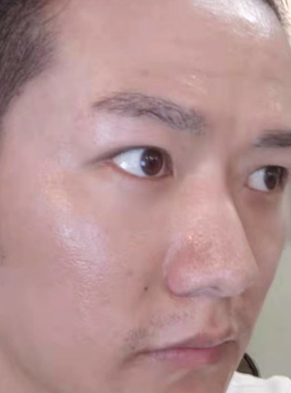 去眼袋手术