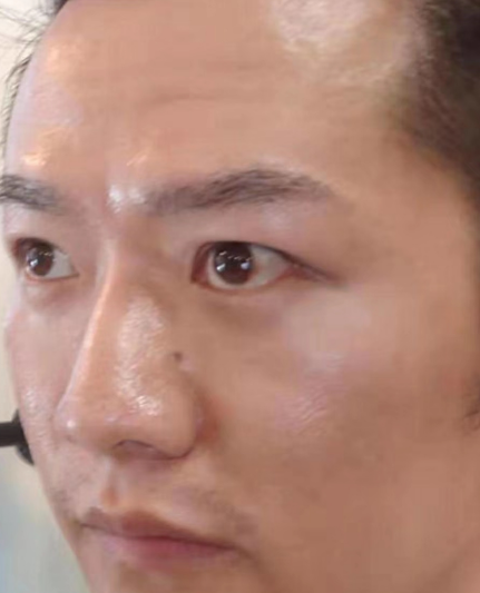 去眼袋手术