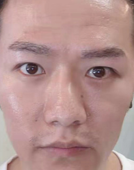 去眼袋手术