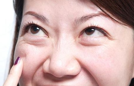 去眼袋手术