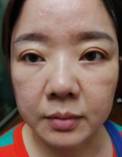 去眼袋手术