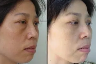 去眼袋手术