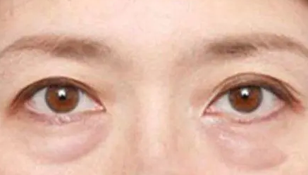 去眼袋手术