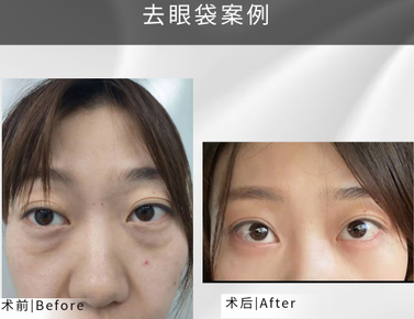 去眼袋手术
