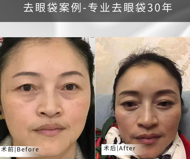 去眼袋手术