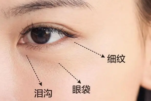 去眼袋手术