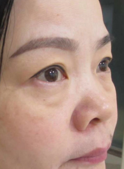 去眼袋手术