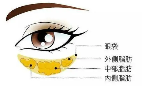 去眼袋手术