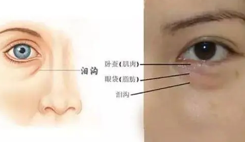 去眼袋手术