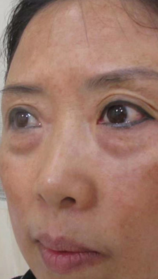 去眼袋手术