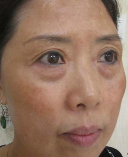 去眼袋手术
