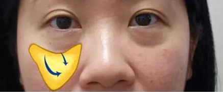 去眼袋手术