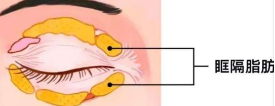 去眼袋手术