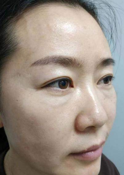 去眼袋手术