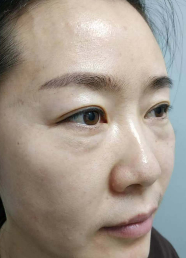去眼袋手术