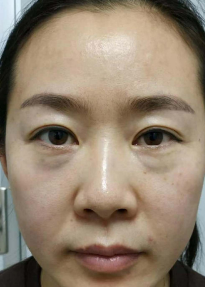 去眼袋手术