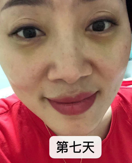 去眼袋手术