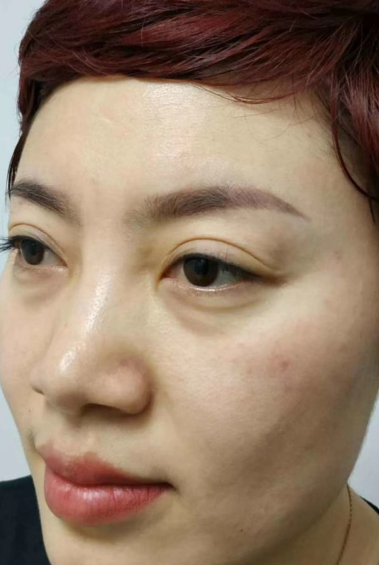 去眼袋手术