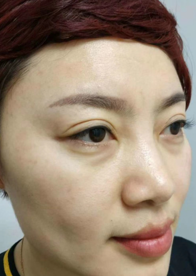 去眼袋手术