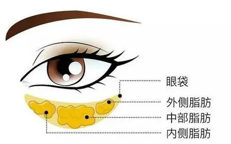 去眼袋手术