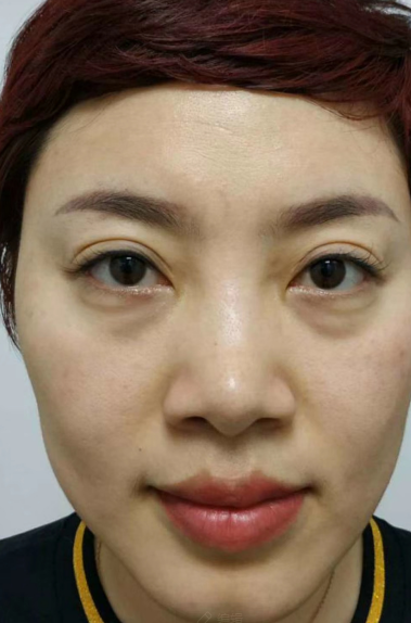 去眼袋手术