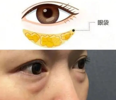 去眼袋手术