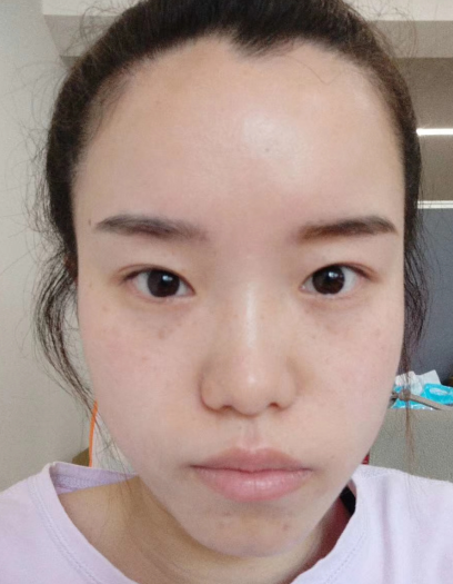 去眼袋手术