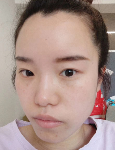 去眼袋手术
